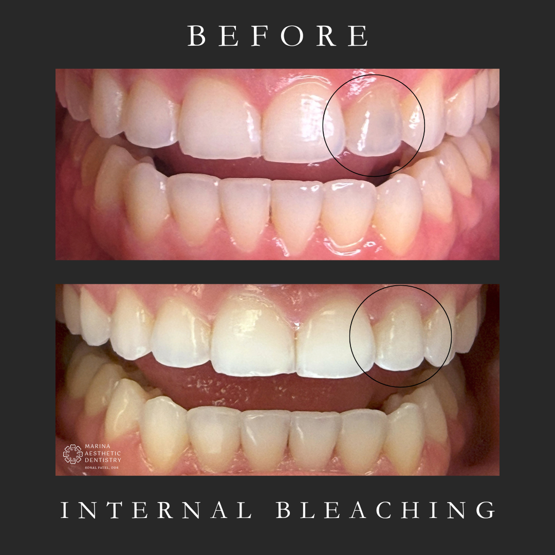 internal bleaching before and after