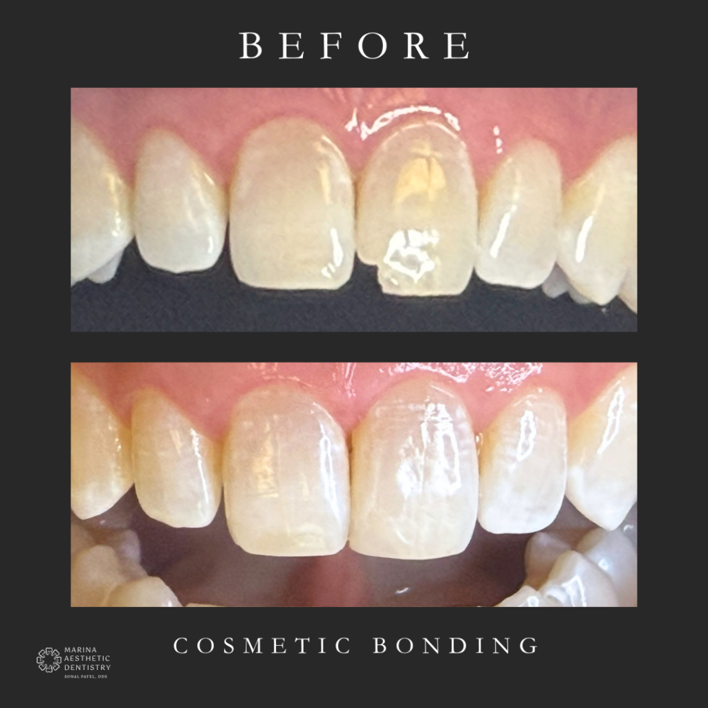 cosmetic bonding before and after