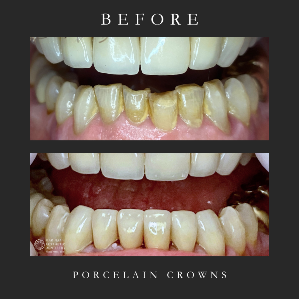porcelain crowns before and after