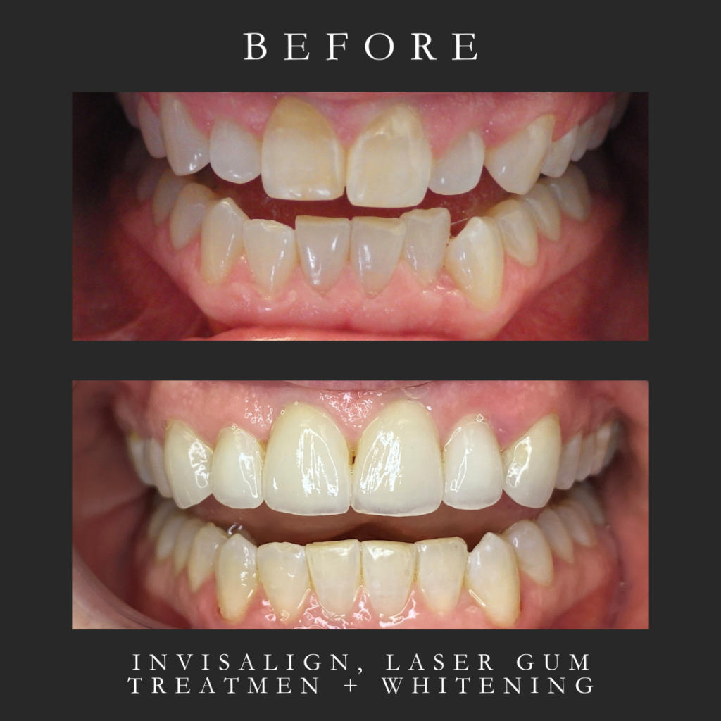 Invisalign + whitening + laser before and after